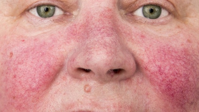 How to Care for Rosacea