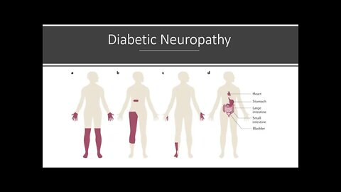 Diabetic Neuropathy - Natural Treatment