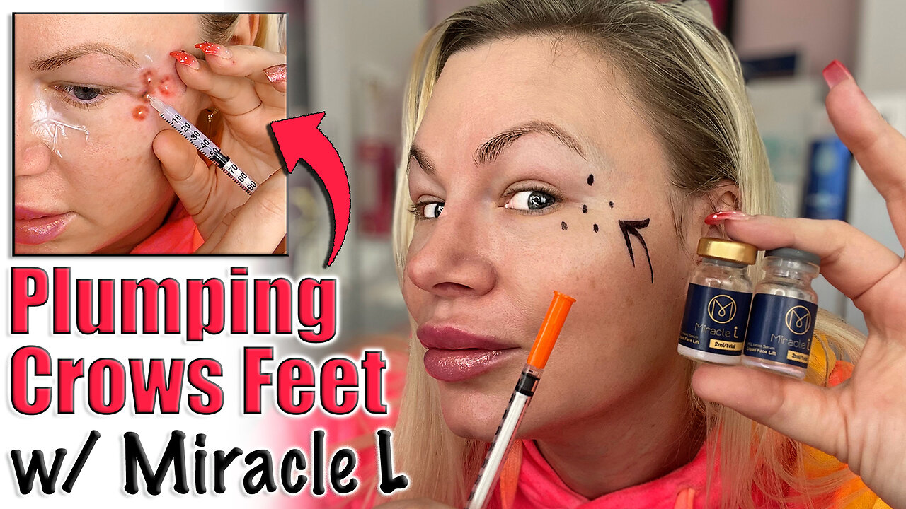 Plumping Crows Feet with Miracle L! AceCosm.com | Code Jessica10 Saves you money!