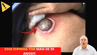 Espremendo Espinha Inteira Inflamada Gigantes no Rosto - vídeo satisfatório - (giant spine)