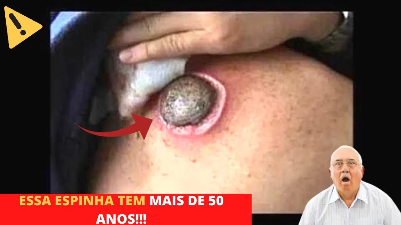 Espremendo Espinha Inteira Inflamada Gigantes no Rosto - vídeo satisfatório - (giant spine)