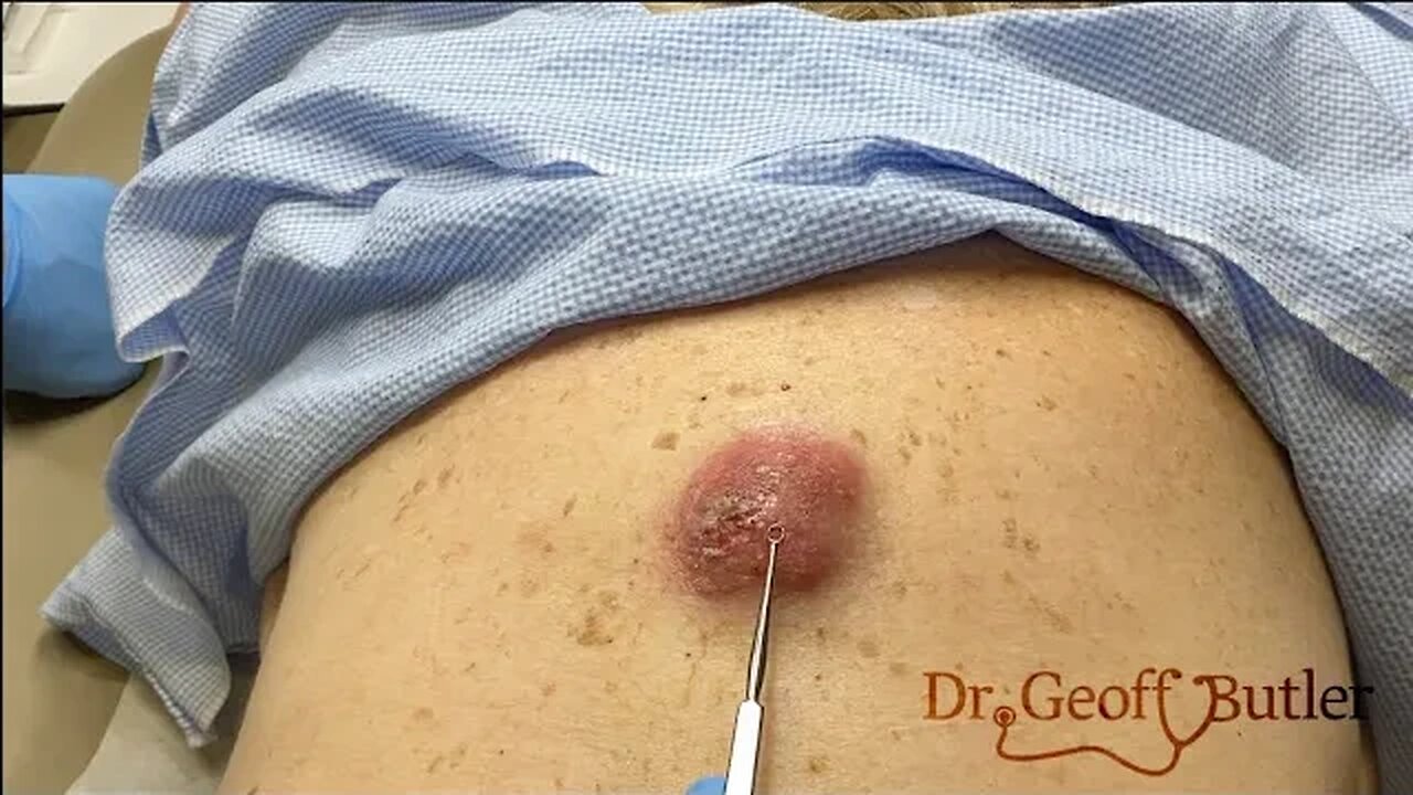 Drainage of an infected cyst on the back