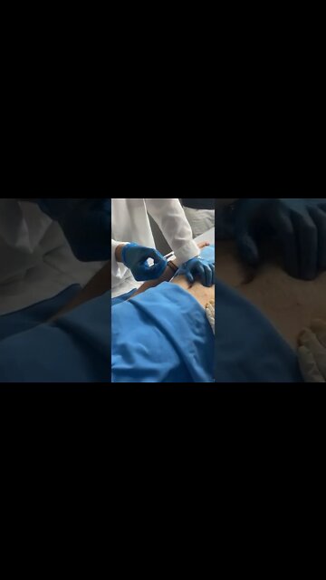 Worlds longest ingrown hair