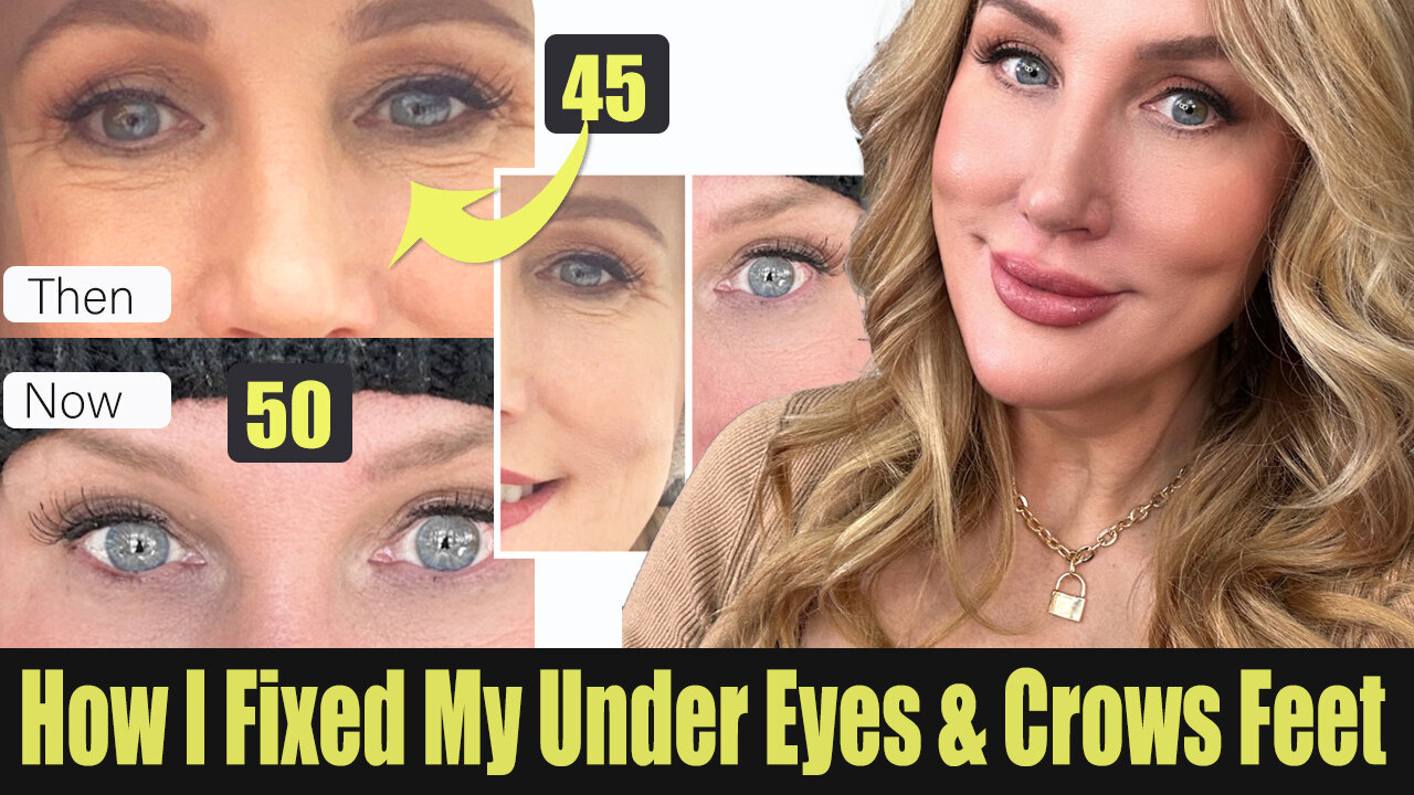 Burning Question // How I've Transformed My Under-eyes!