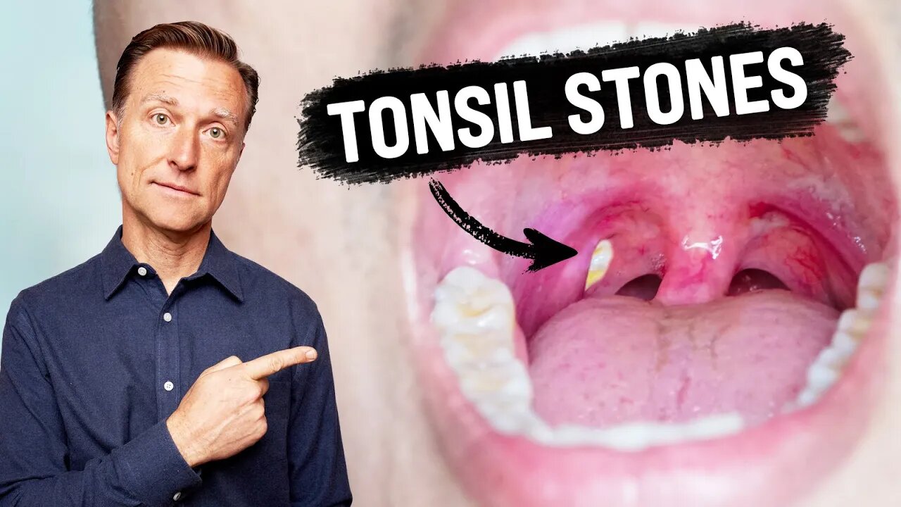 What CAUSES Tonsil Stones and How to Prevent Them