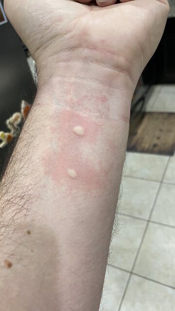 BAD reaction to bites!