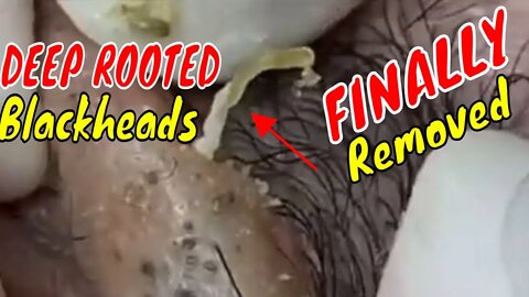 Deep rooted blackheads FINALLY getting removed 😮‍💨 #blackheadremoval #blackhead #satisfyingvideos