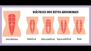 3 Exercícios para Diástase Abdominal