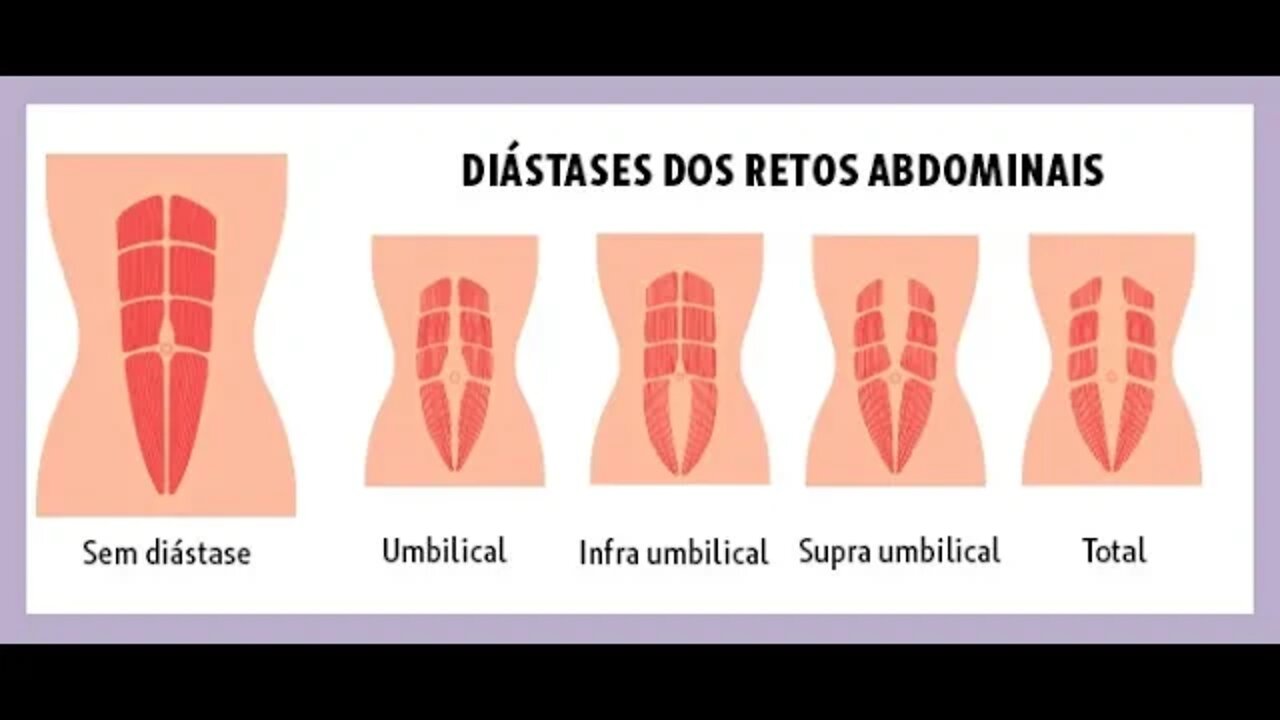 3 Exercícios para Diástase Abdominal