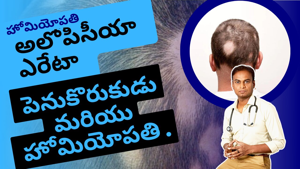 అలోపేసియా ఏరియాటా హోమియోపతిక్ చికిత్స .Dr. Bharadwaz | Homeopathy, Medicine & Surgery