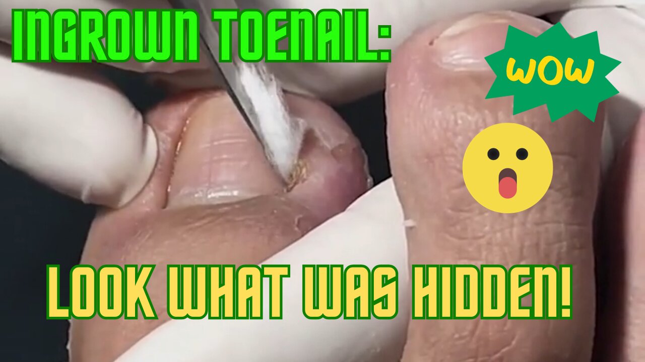 Ingrown Toenail: Look what was hidden!