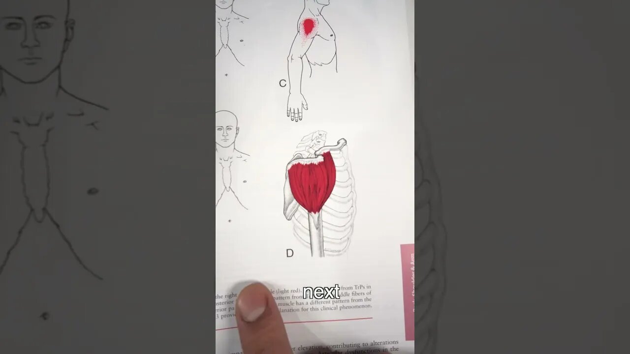 These Trigger Points Create Shoulder Pain