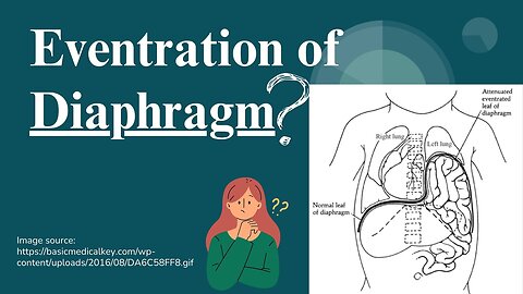 Eventration of Diaphragm: Causes, Symptoms, and Treatment | Novice Medic