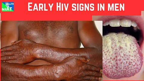 EARLY HIV SIGNS IN MEN