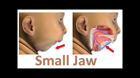 What is the Main Reason of Small Jaw (Micrognathia) by Prof John Mew