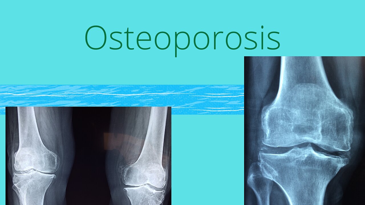 Osteoporosis y Agua de Mar