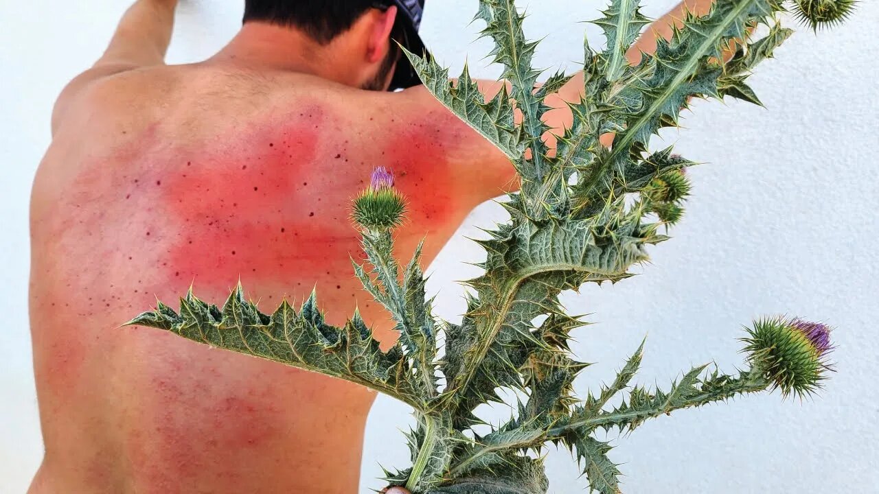 The WORST Thistle injury on the internet.