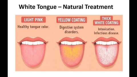 White Tongue - Natural Treatments & Causes