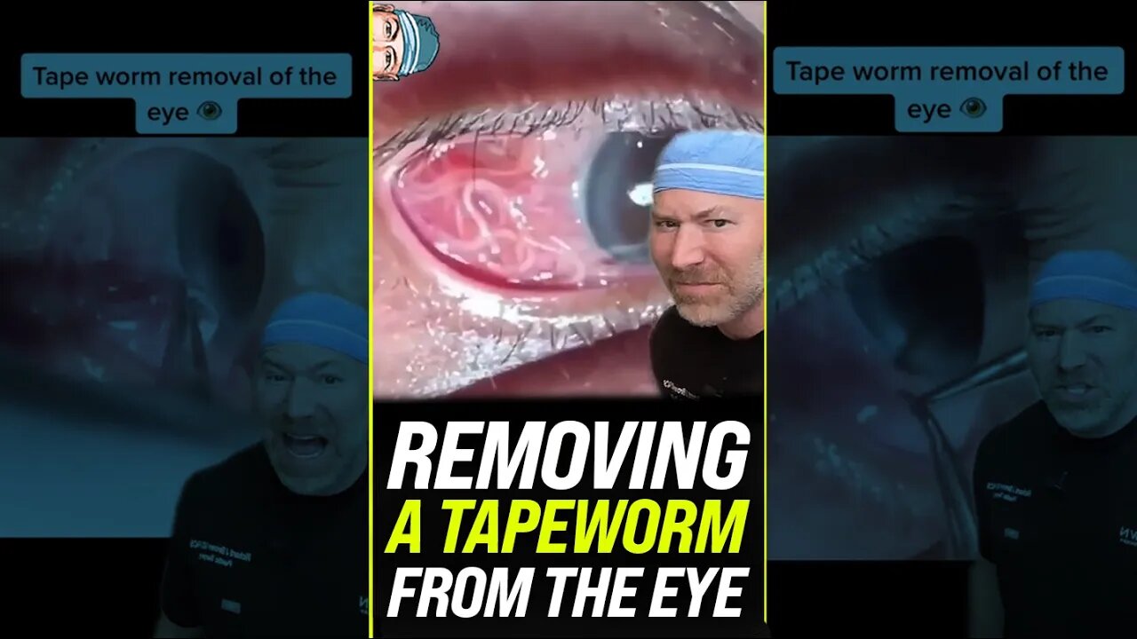 Removing a Tapeworm from the Eye 😱 #shorts