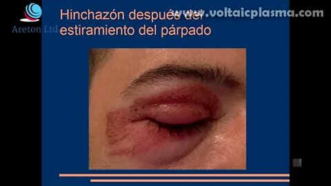 PLASMA Y ESTIRAMIENTO DE PIEL LOCALIZADA ACTO VI GUATEMALA