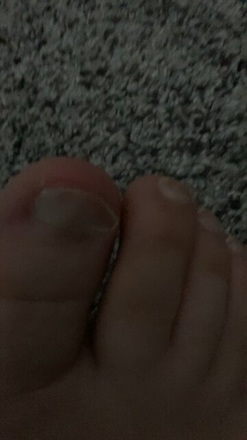 Cut my toenail too short!