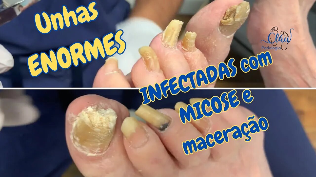 Unhas ENORMES infectadas com MICOSE muita maceração!! #unhas #pes #dor #podologia #procedimento