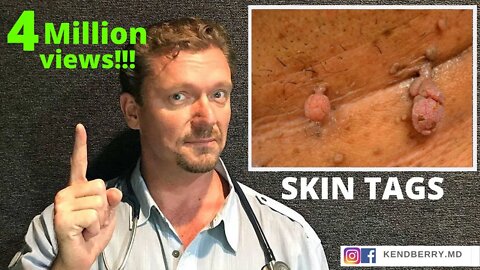 What SKIN TAGS Really Mean (Does your Doctor know?)