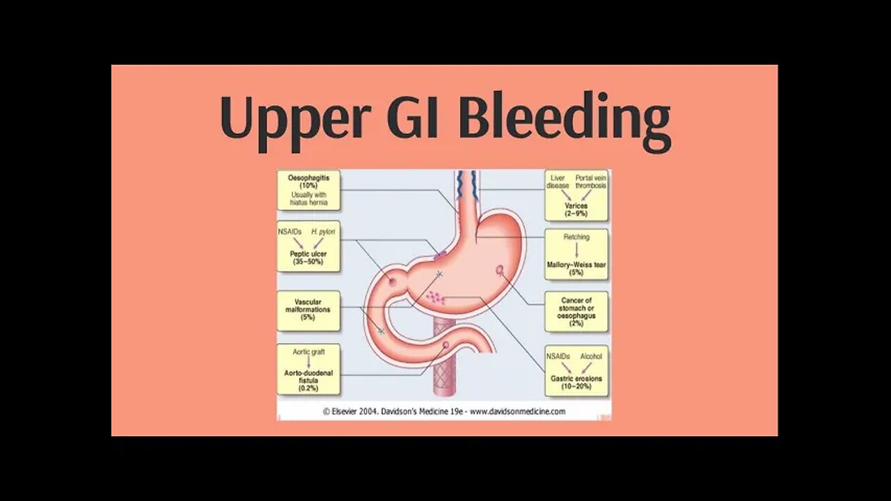 Upper Gastrointestinal Bleeding (Variceal and Non Variceal) | Novice Medic