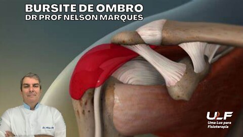 BURSITE DE OMBRO - Dr. Prof. Nelson Marques