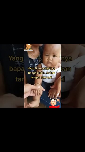 viral bayi punya jari2 kaki dan tangan masing2 6. total 24 jari