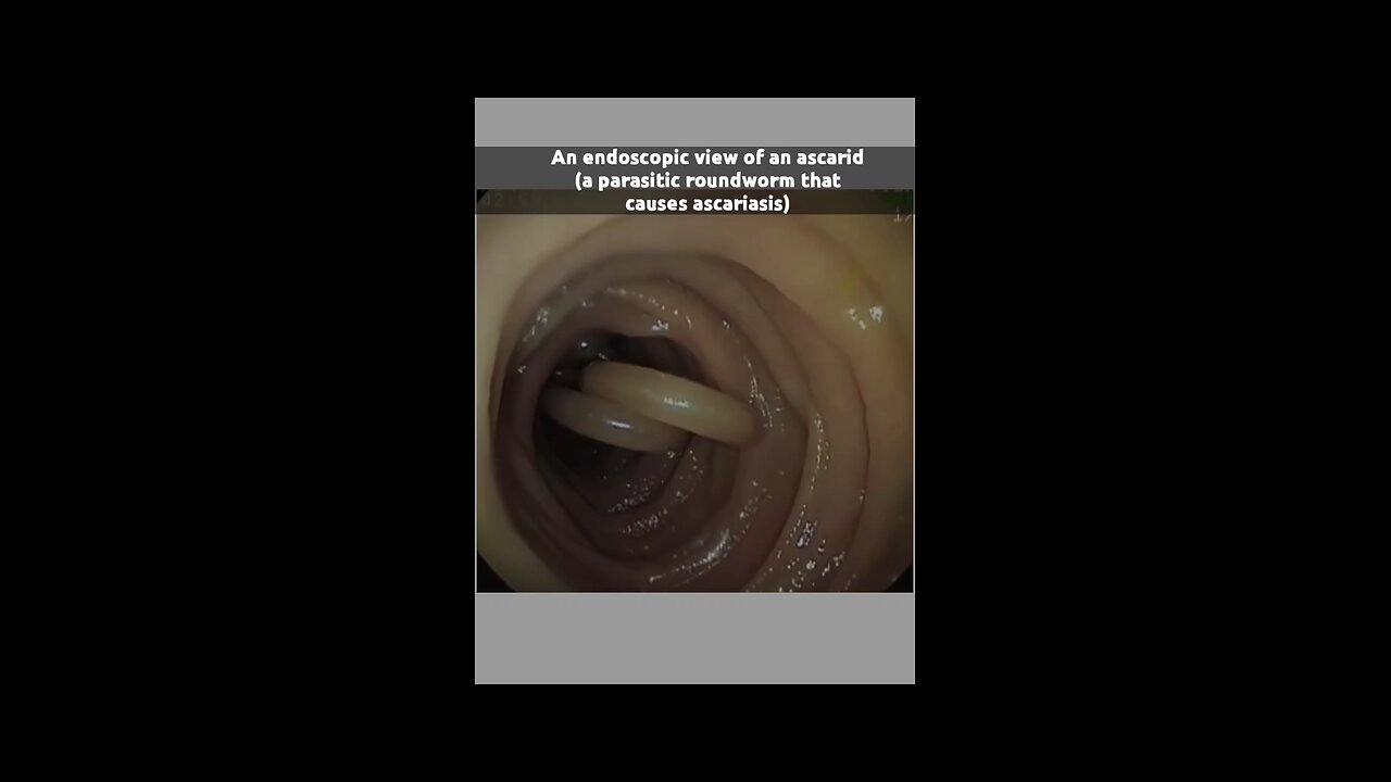 ascaris infection of gut