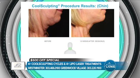 Coolsculpting Gets Results! // MD Body & Med Spa