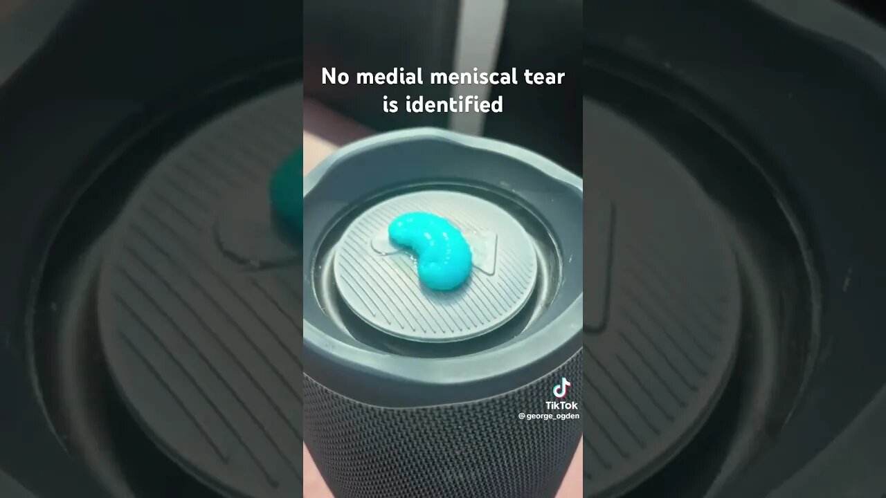 Medial meniscus be like….#medicine