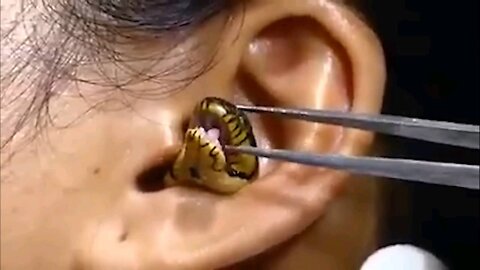 Removing live snake from a human ear