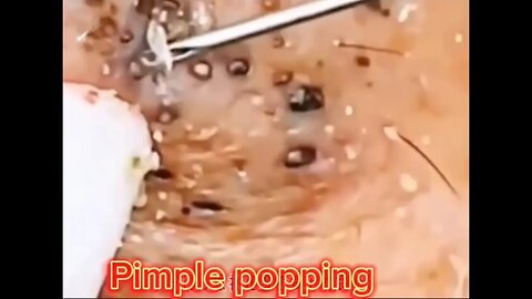 Big big blackheads 😱 Pimple popping