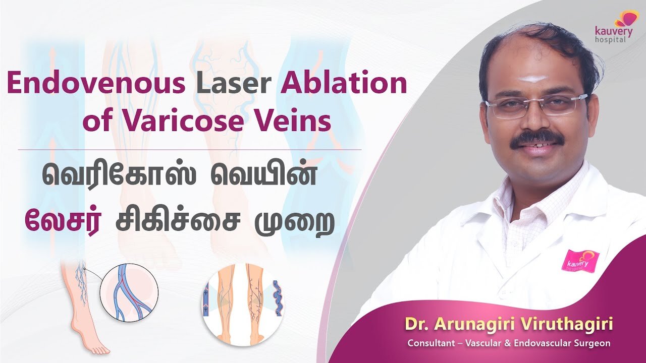 Endovenous Laser Ablation of Varicose Veins