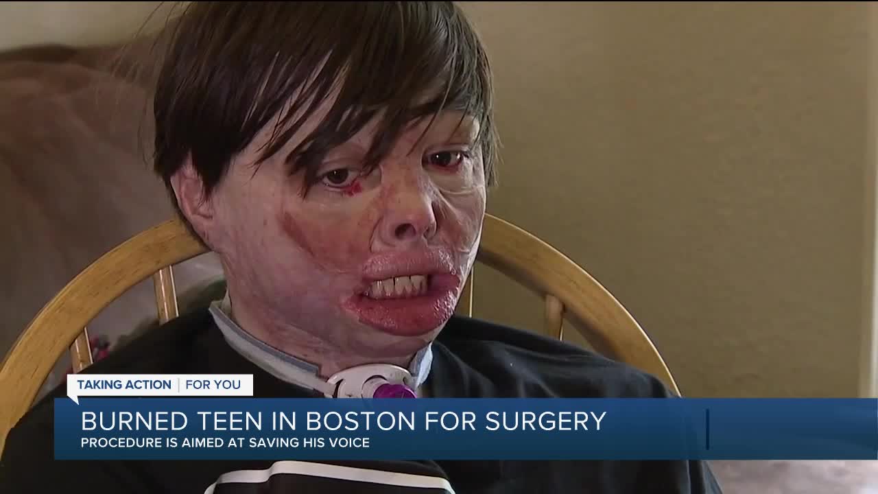 Burned teen in Boston for surgery