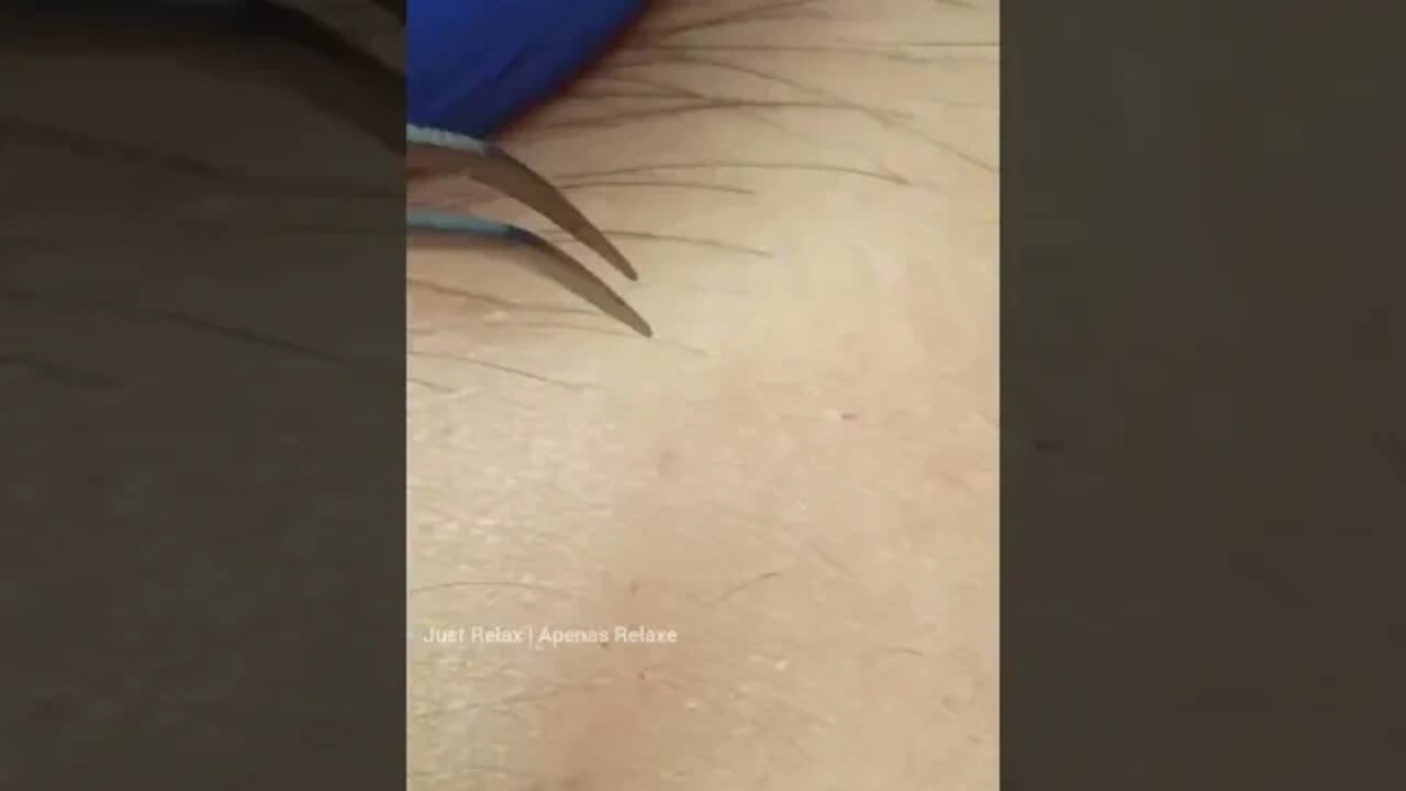 Vídeo Satisfatório Eletrólise Depilação Elétrica Definitiva 3 - Relaxing and Satisfying Electrolysis