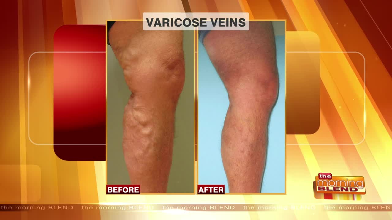 Exploring Vein Issues, Symptoms, and Solutions