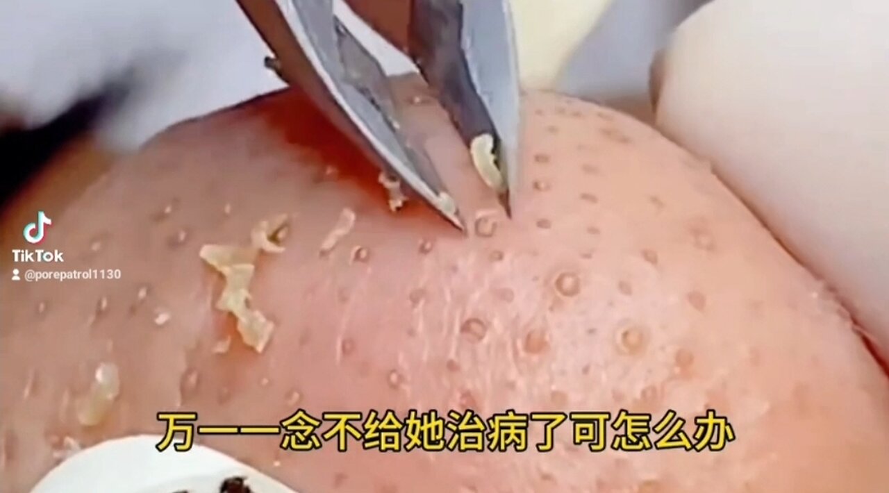 Amazing Whiteheads Removal!!