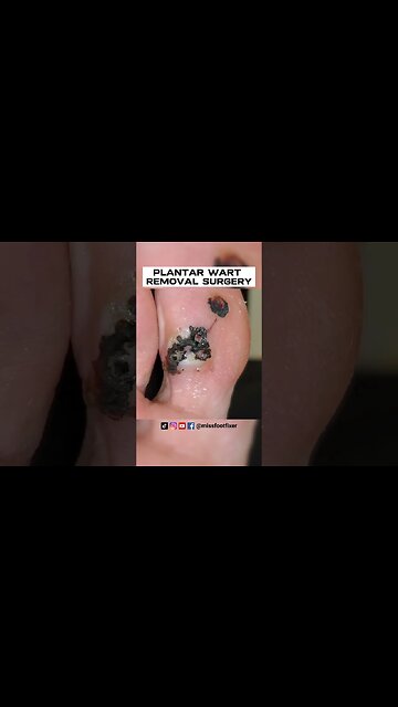 WOW! HUGE FOOT WART EVER??? ***PLANTAR WART REMOVAL SURGERY***