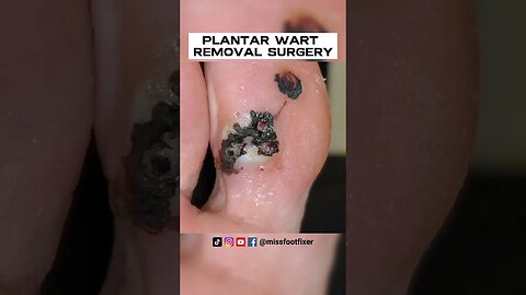 WOW! HUGE FOOT WART EVER??? ***PLANTAR WART REMOVAL SURGERY***