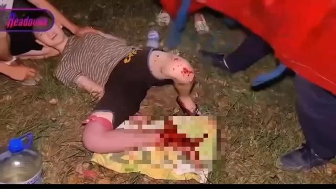 15yo Vladislav from Donetsk became a victim of an insidious "Petal" mine