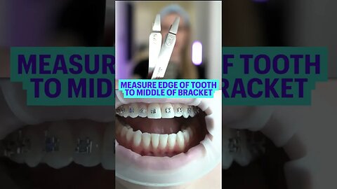 How Braces Are Put On | Braces Colors