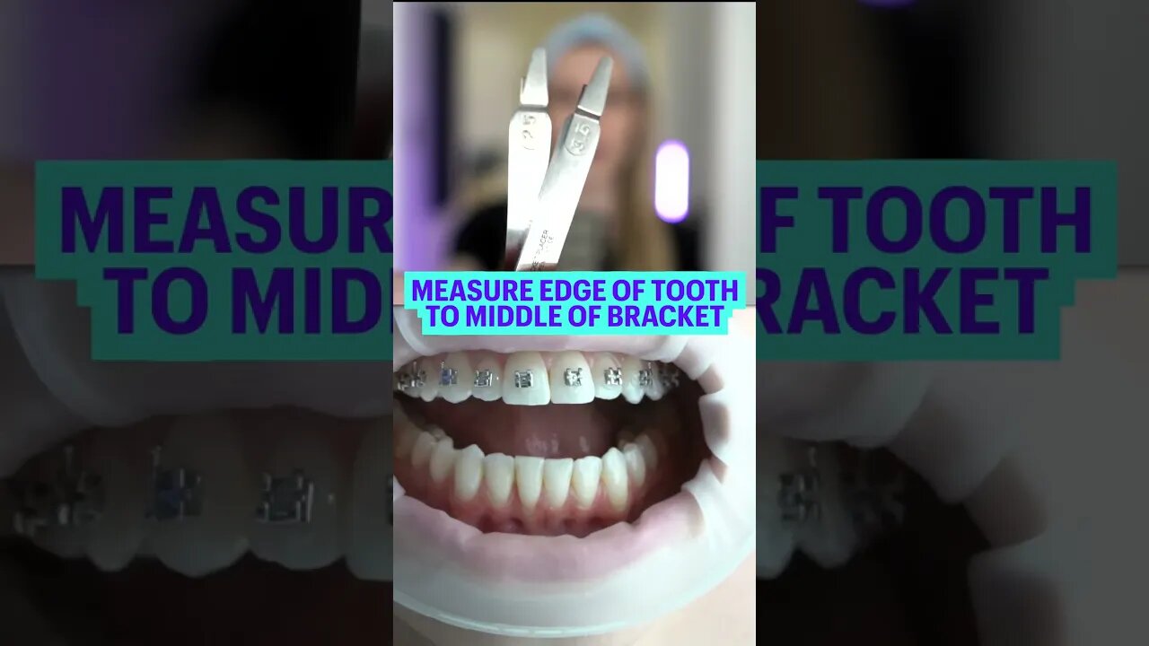 How Braces Are Put On | Braces Colors