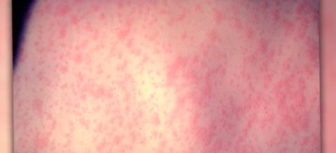 Measles warning issued after adult diagnosed in Las Vegas