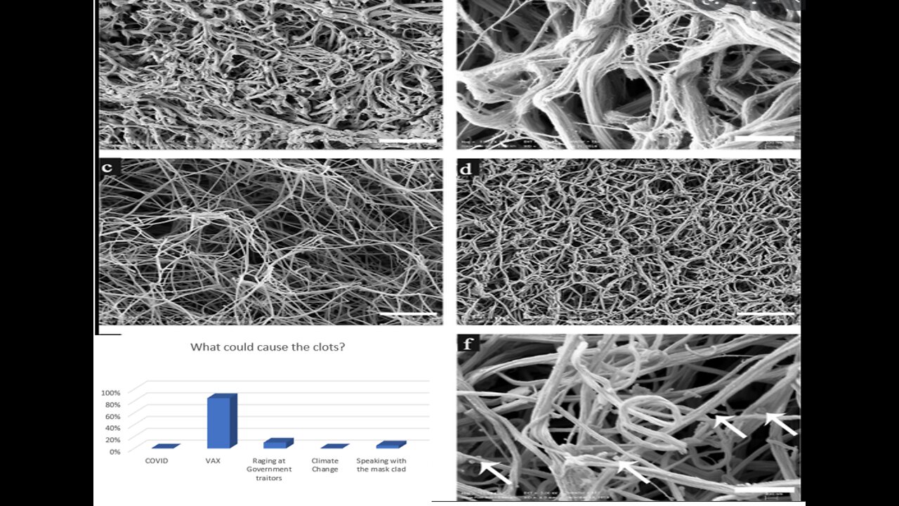 Embalmers finding fibrous clots in 50-70% of all corpses. What could be the cause?