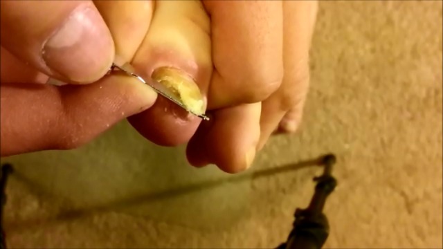 Toe Nail Fungus - Why Foot Hygiene is Important - 1 Week Into Lamisil