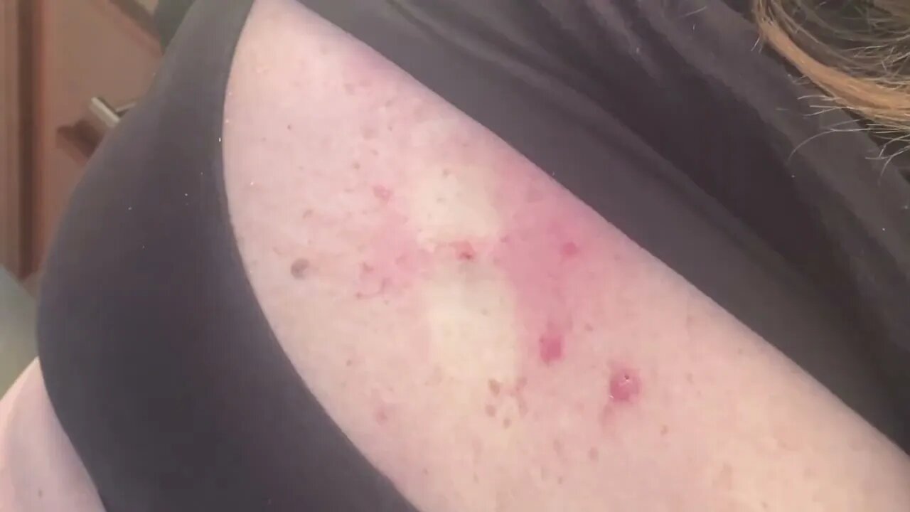 HARD POP on a 15 YEAR OLD Cyst | SATISFYING Release - #TheBubbaArmy