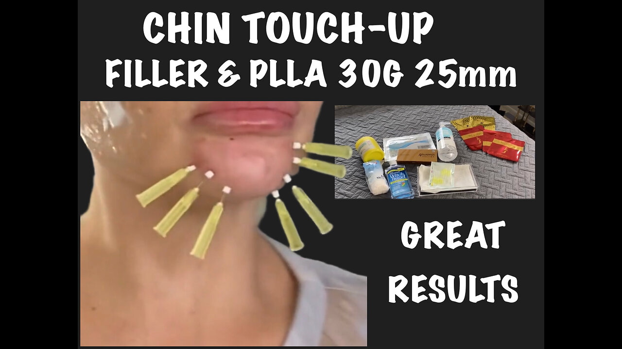 Chin Enhancement Using Neuramis Volume & PLLA